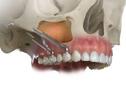 Zygomatic Implants Treatment Services