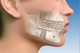 Jaw Bone Fracture Treatment Services